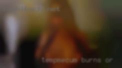 TempMecum Burns OR